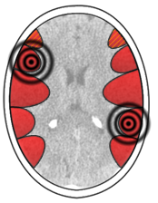 autistisch konstellation revier hirn ct hamerscher herd hh